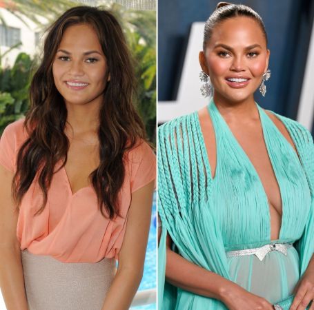 Chrissy Teigen had breast implant surgery.